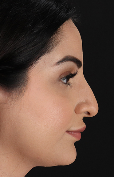 Before - right_lateral