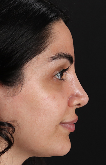 After - right_lateral