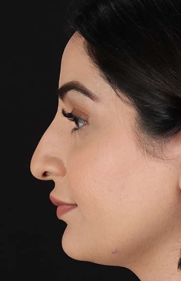 Before - left_lateral