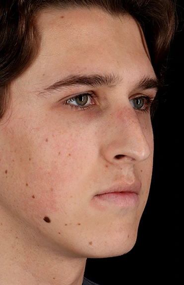 Before - right_oblique