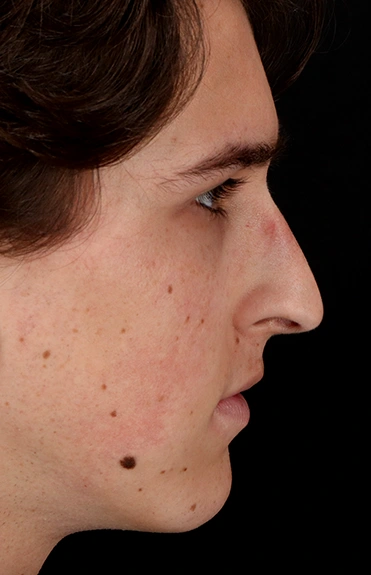 Before - right_lateral