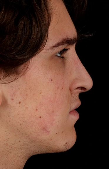 After - right_lateral