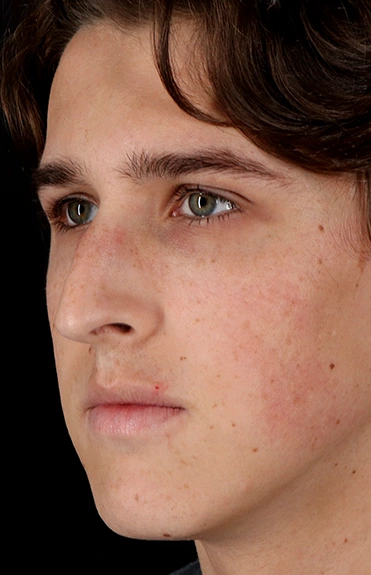 Before - left_oblique