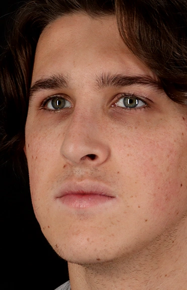 After - left_oblique