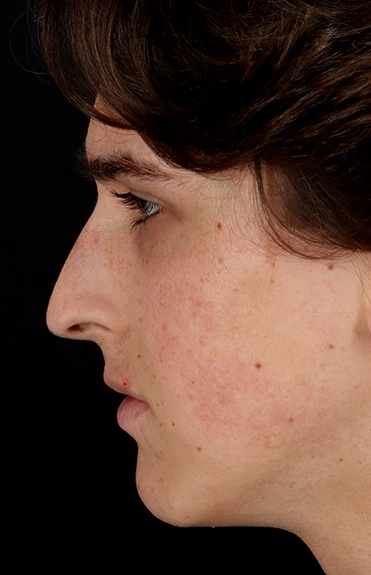 Before - left_lateral