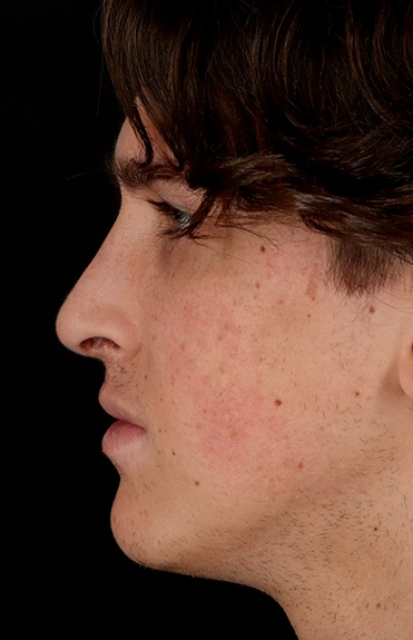 After - left_lateral