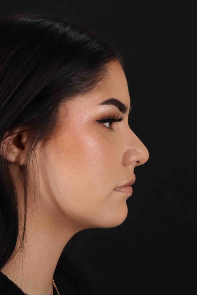 Before - right_lateral