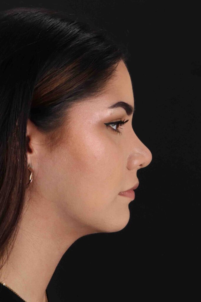 After - right_lateral