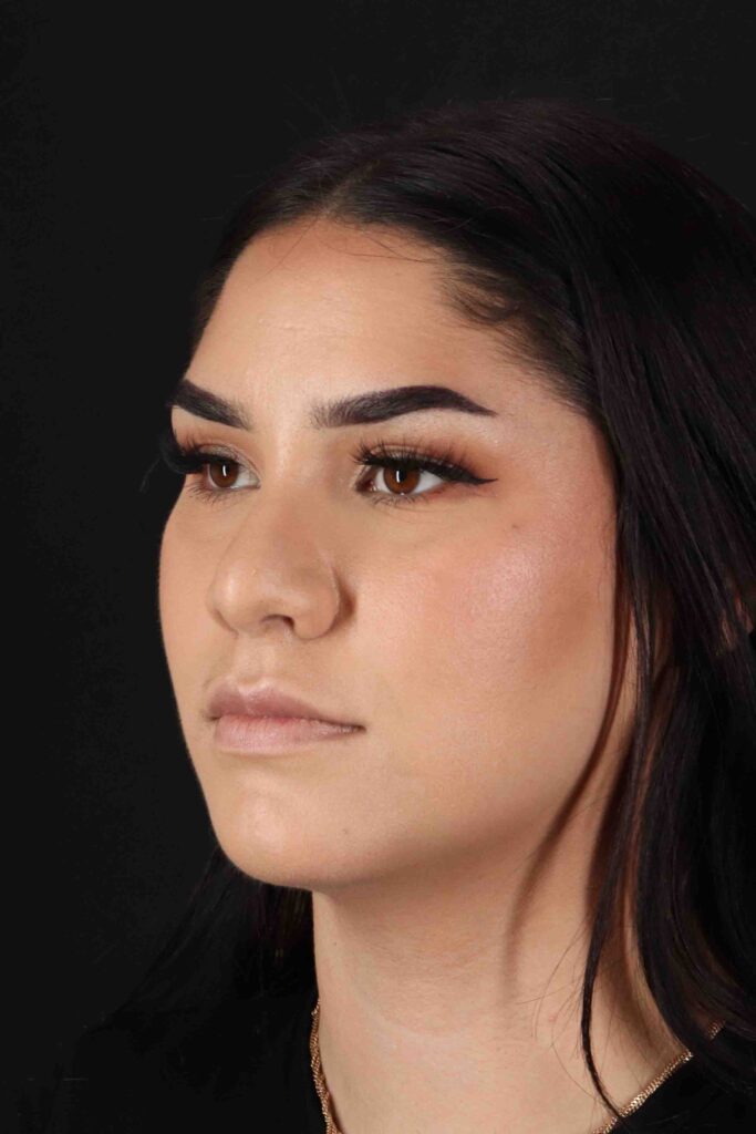 Before - left_oblique