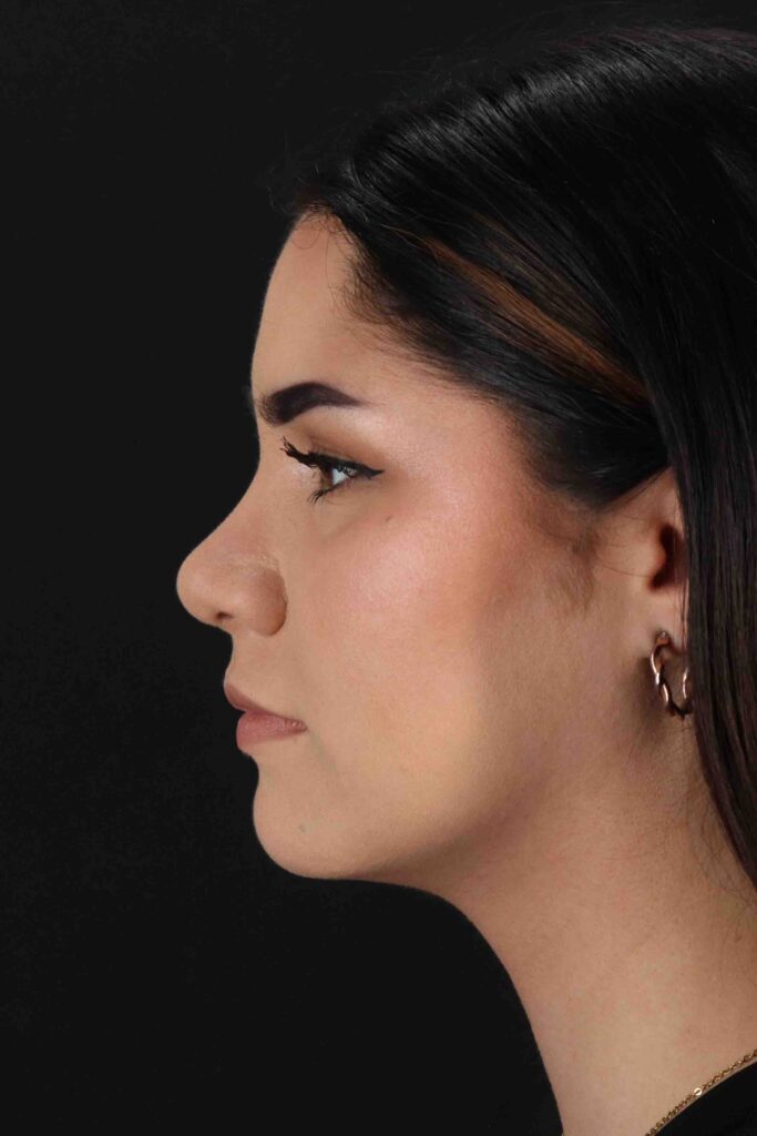 After - left_lateral