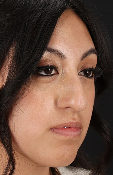 Before - right_oblique