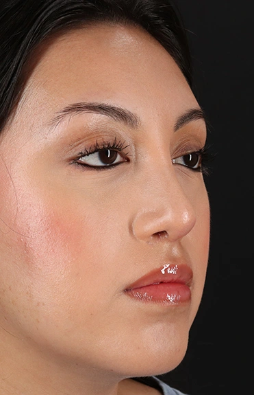 After - right_oblique