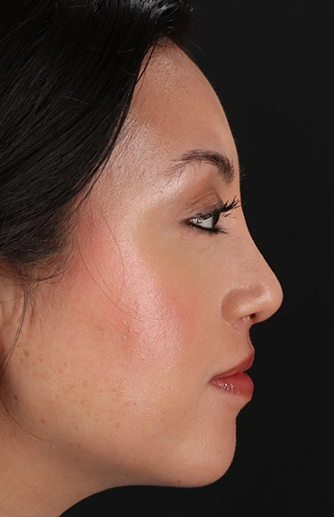 After - right_lateral