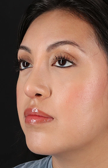 After - left_oblique