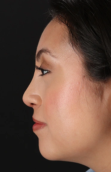 After - left_lateral