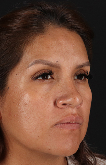 After - right_oblique