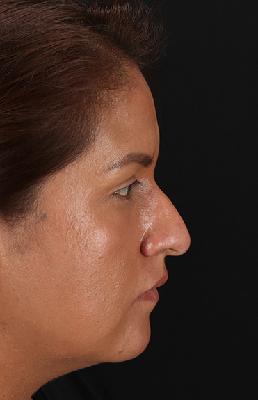 Before - right_lateral