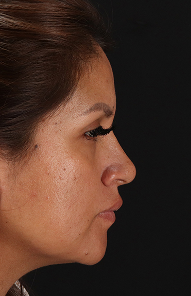 After - right_lateral