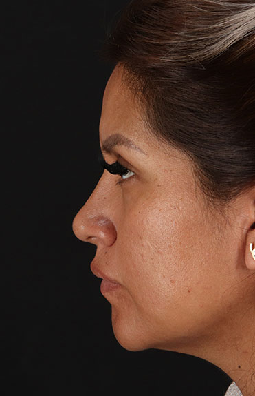 After - left_lateral