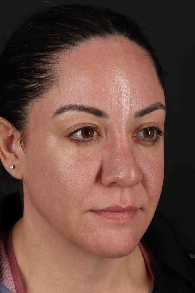 After - right_oblique