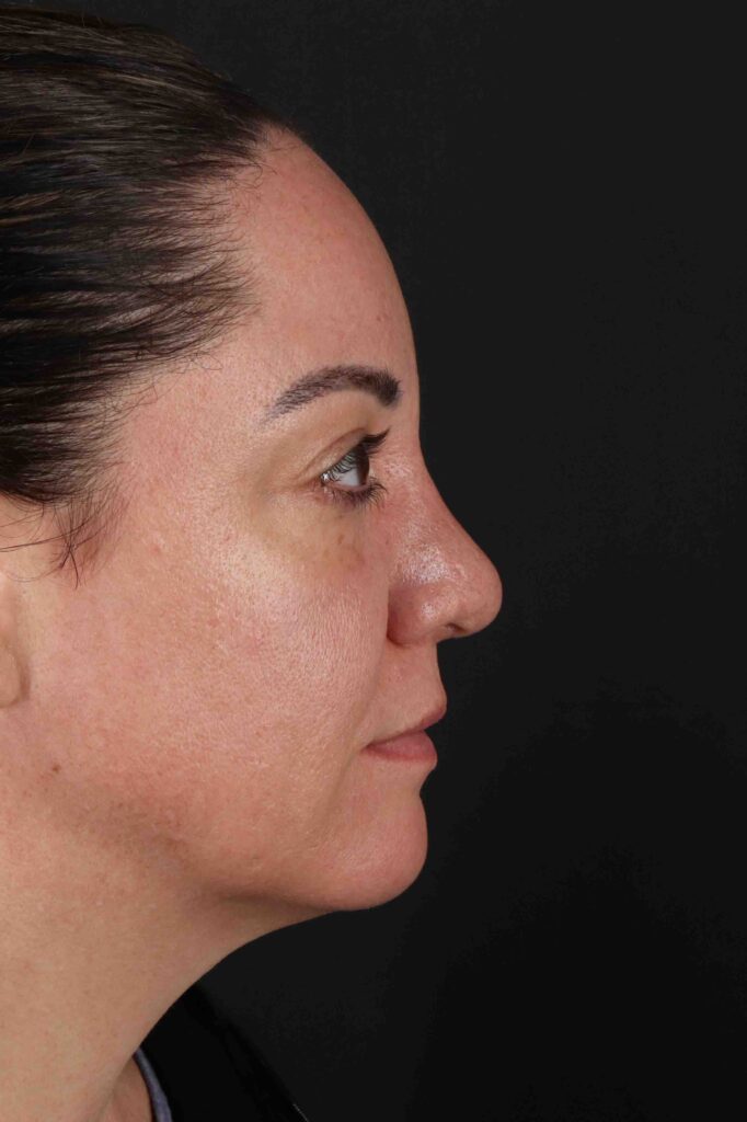 After - right_lateral