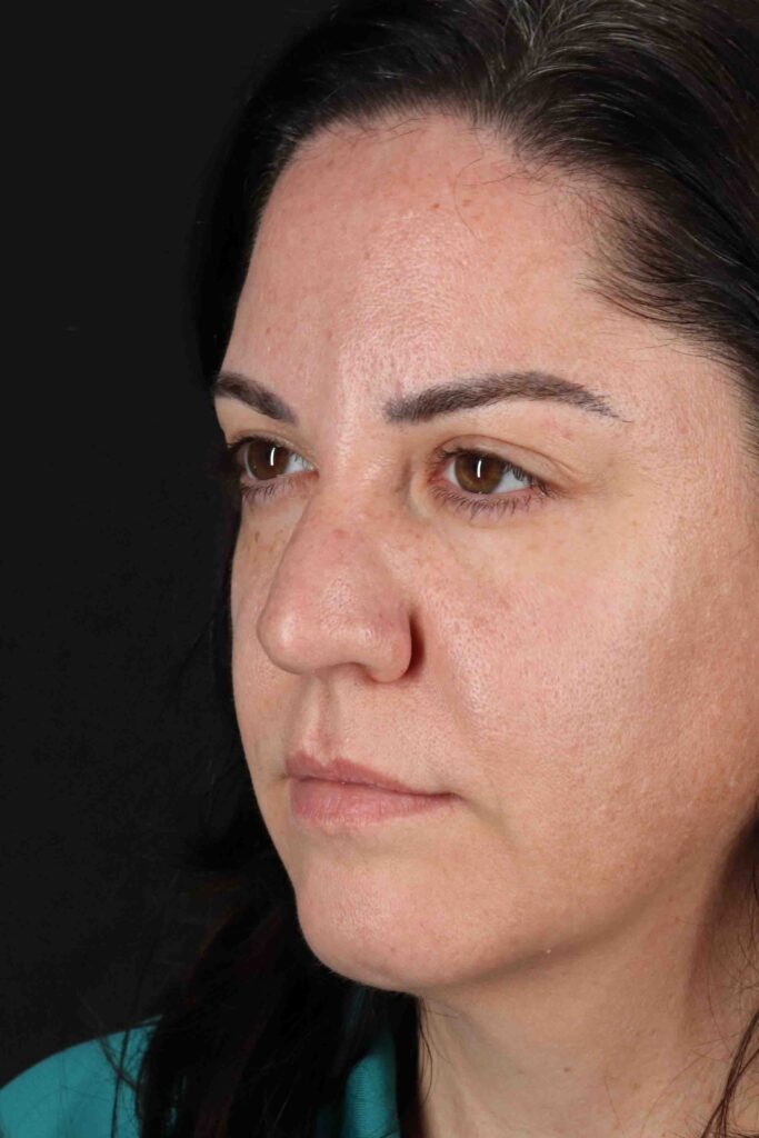 Before - left_oblique