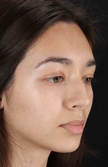 Before - right_oblique