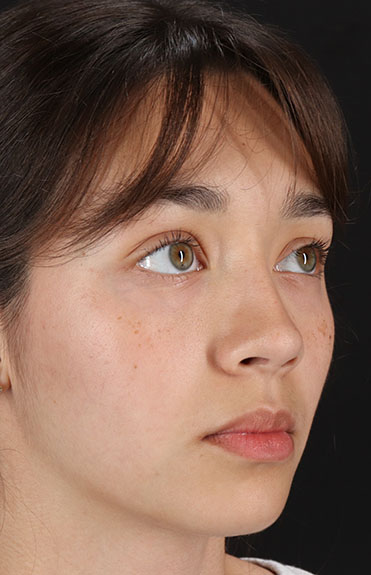 After - right_oblique