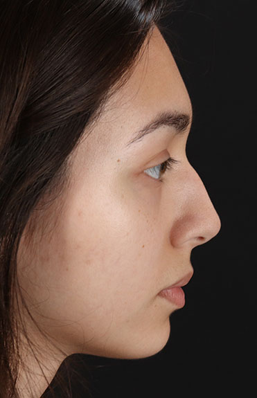 Before - right_lateral