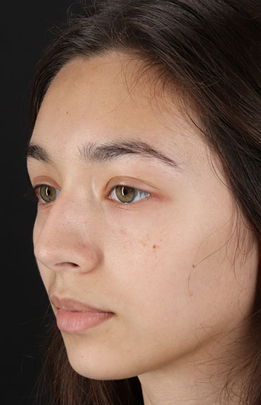 Before - left_oblique