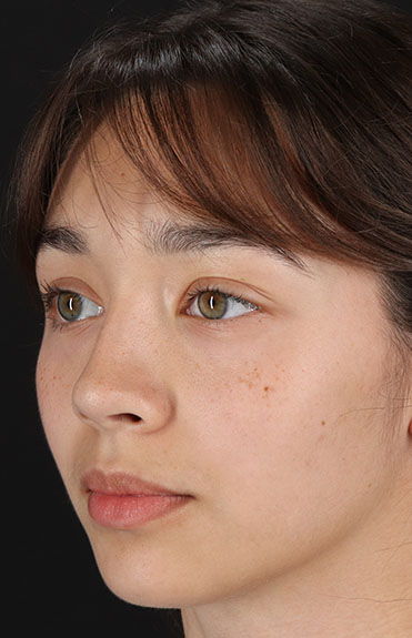 After - left_oblique