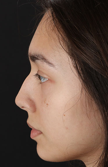 Before - left_lateral