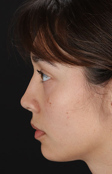 After - left_lateral