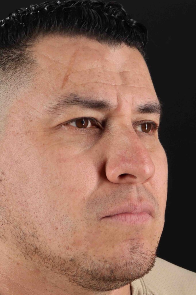 Before - right_oblique