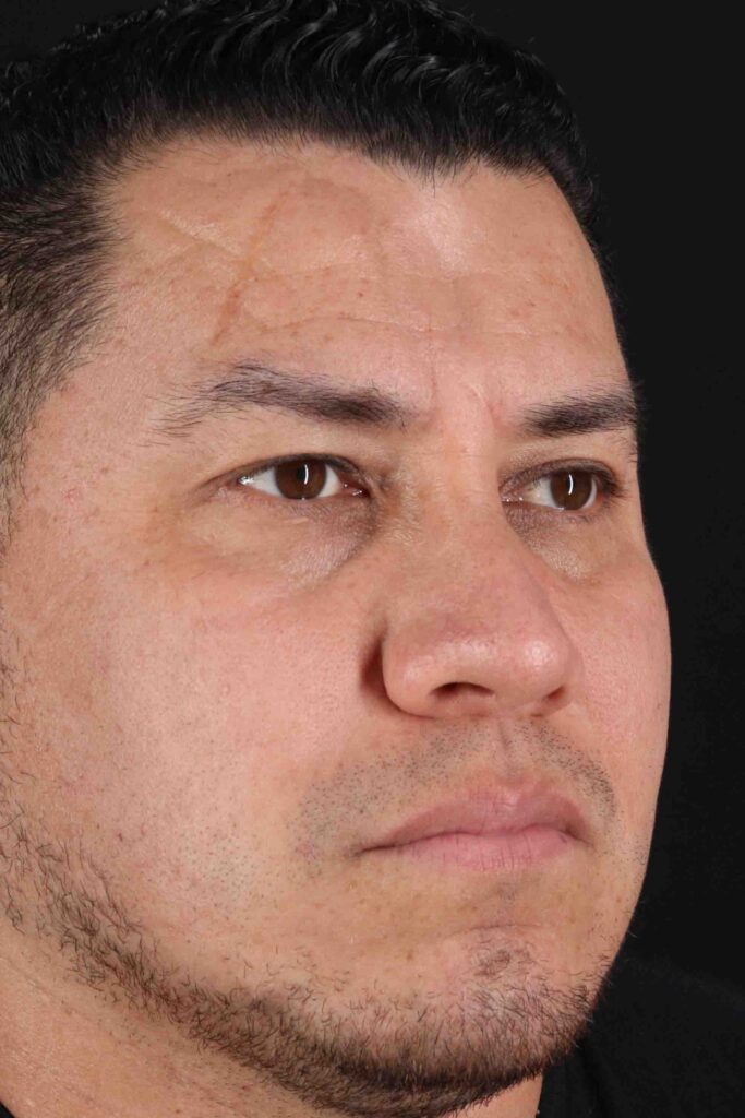 After - right_oblique