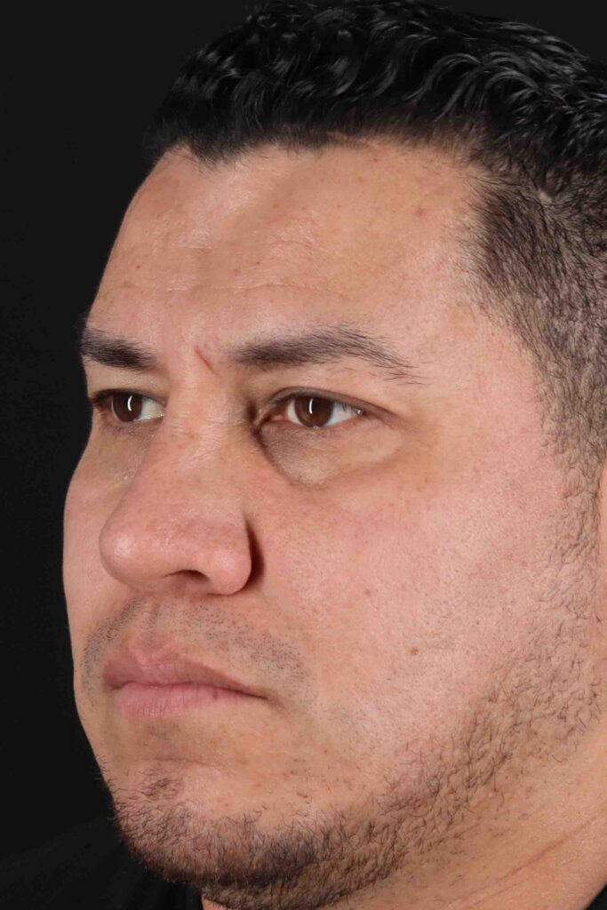 After - left_oblique