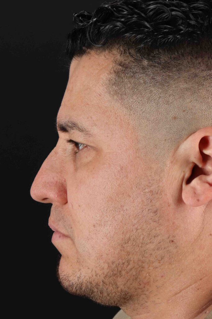 Before - left_lateral