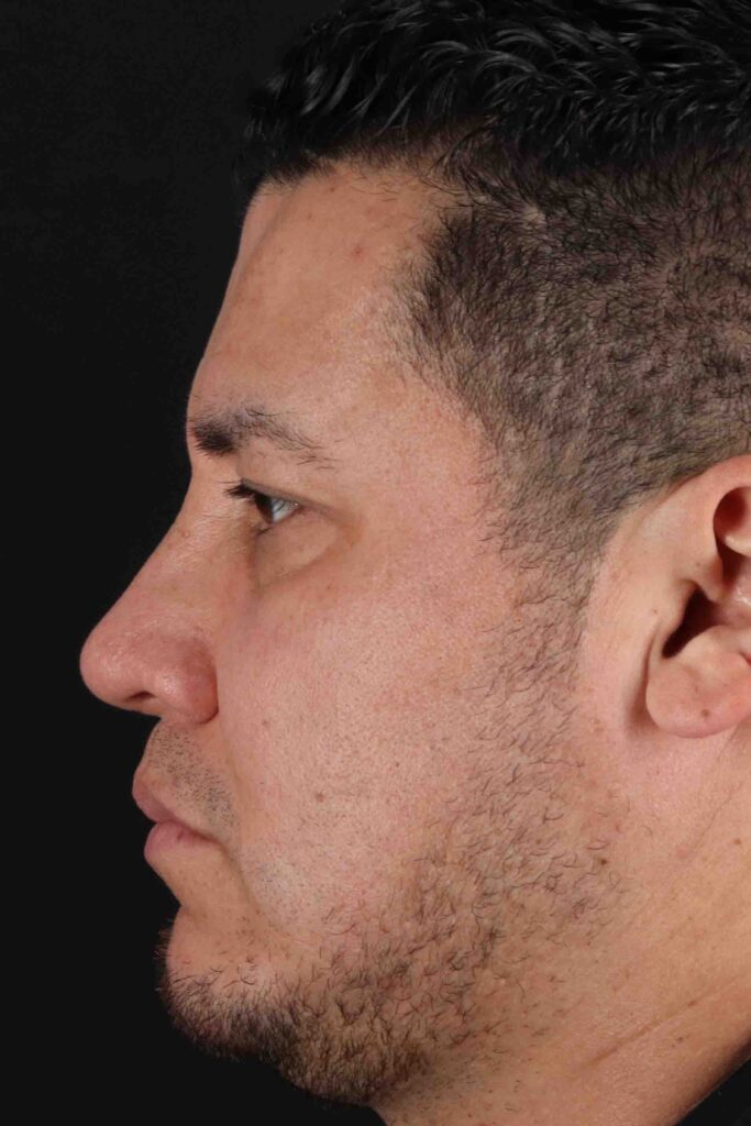 After - left_lateral