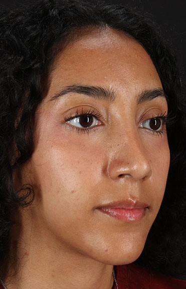 After - right_oblique