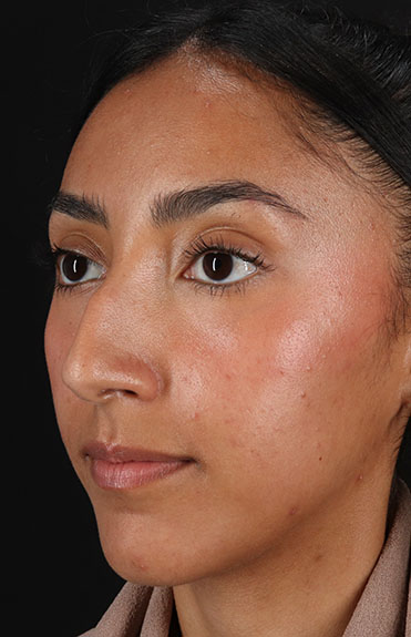 Before - left_oblique