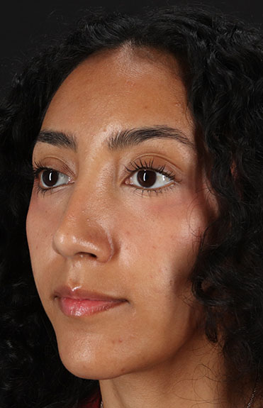 After - left_oblique