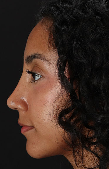 After - left_lateral