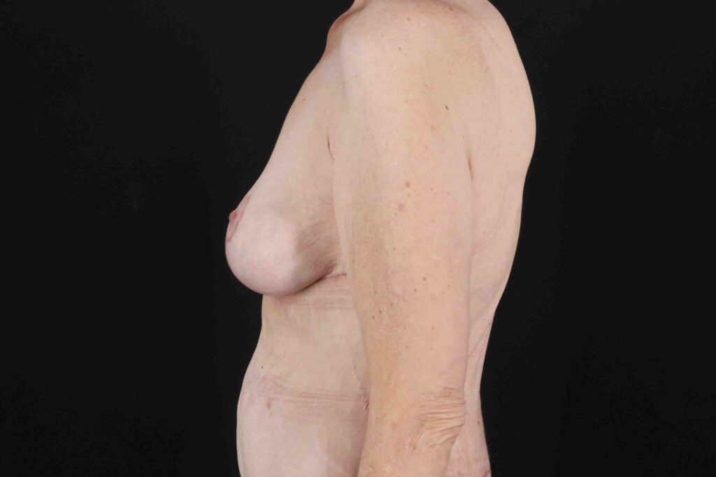 After - left_lateral