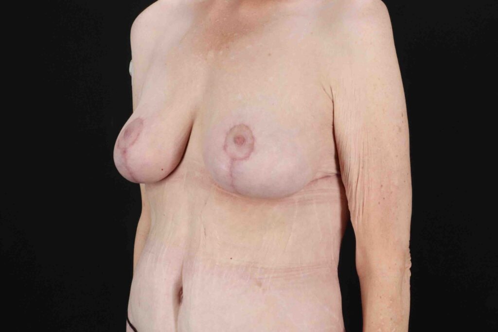 After - left_oblique