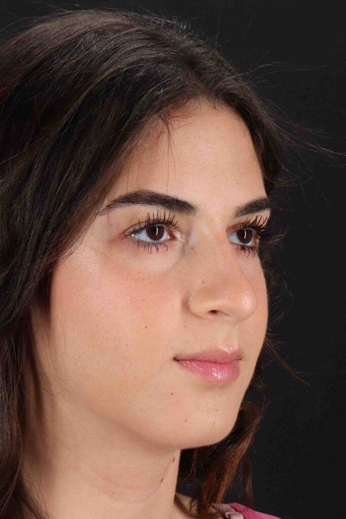 Before - right_oblique