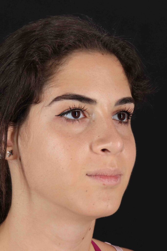 After - right_oblique