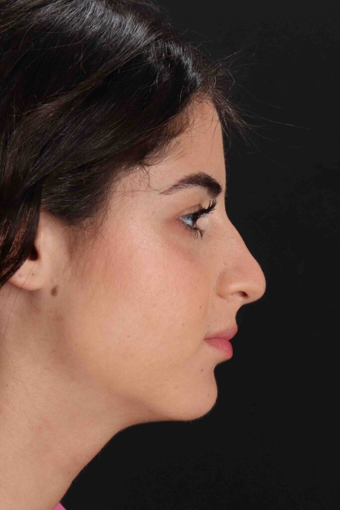 Before - right_lateral