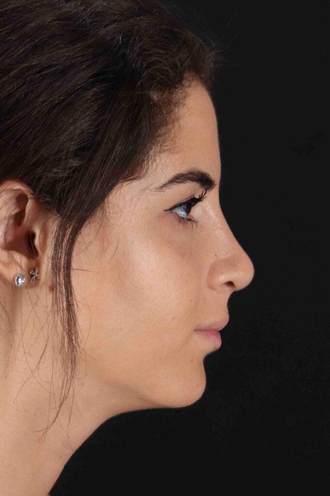 After - right_lateral