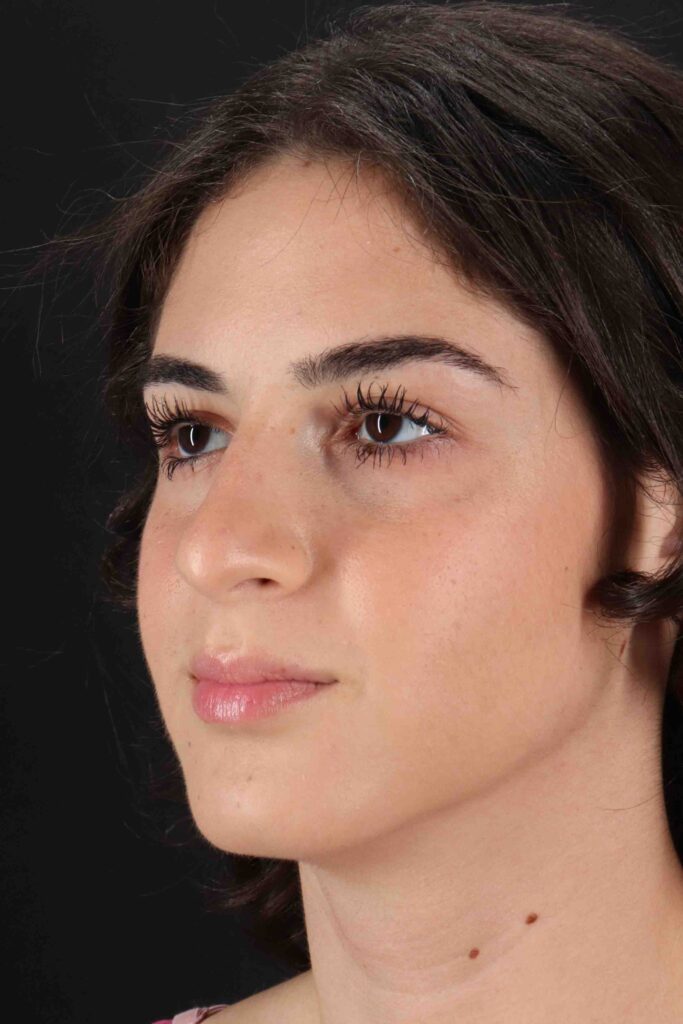 Before - left_oblique