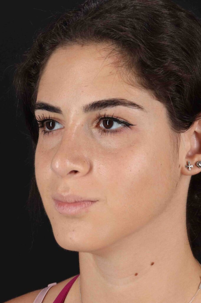 After - left_oblique